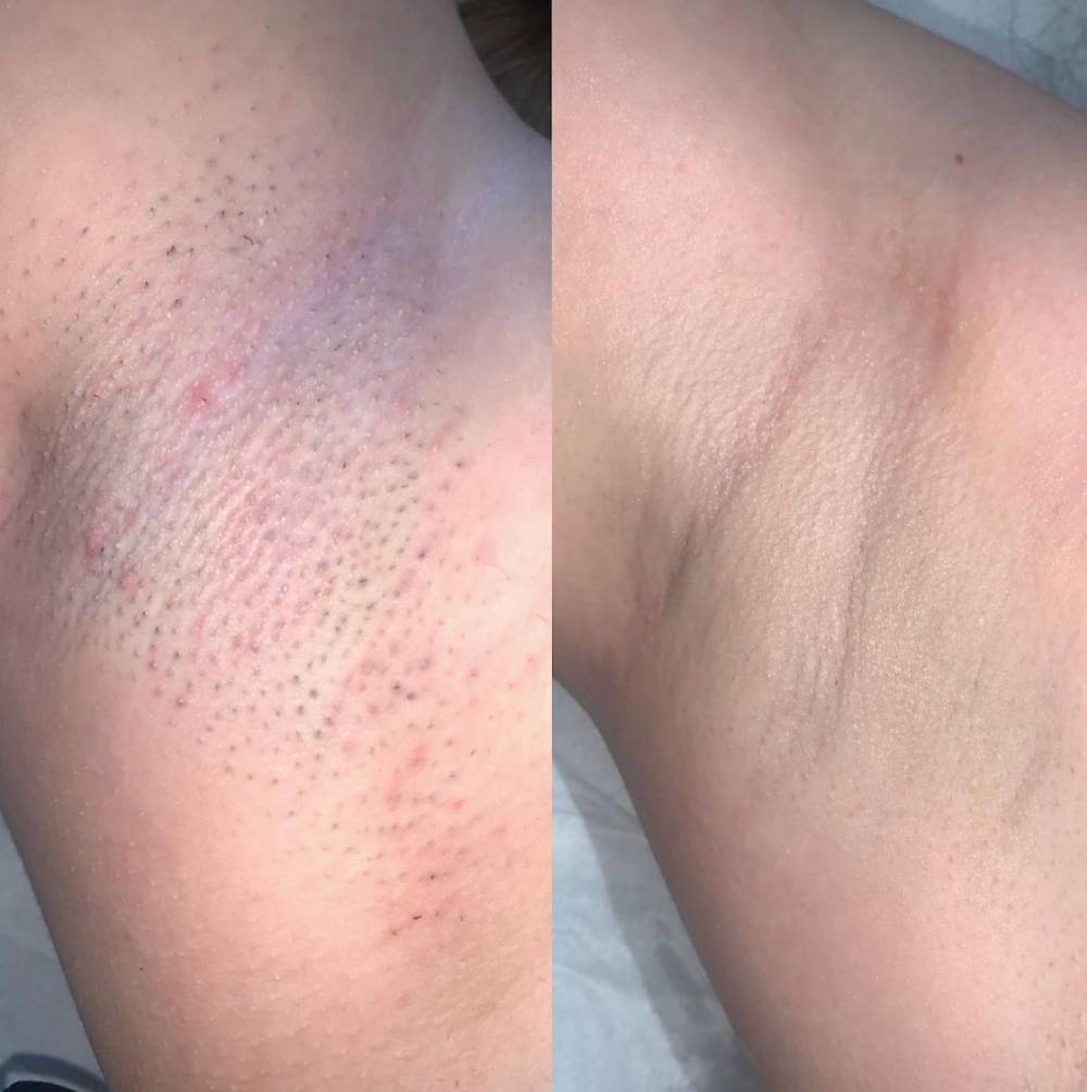 completed underarms package