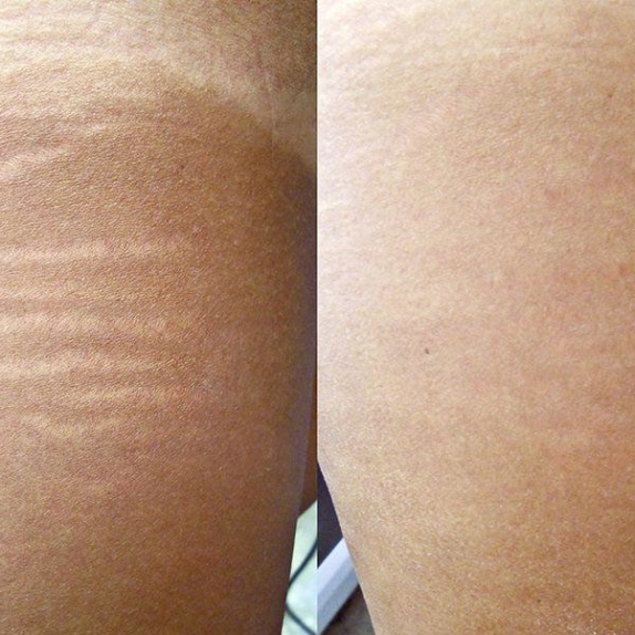 Stretch Mark Treatment in Manchester, Cheshire & Leeds