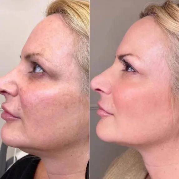 Advanced Skin Resurfacing in Manchester and Cheshire with Stellar M22