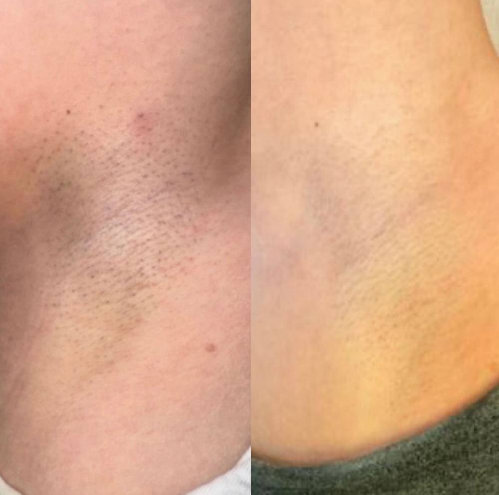 underarms 2 sessions