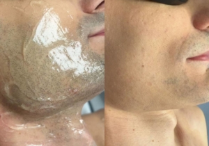 Half face 5 sessions