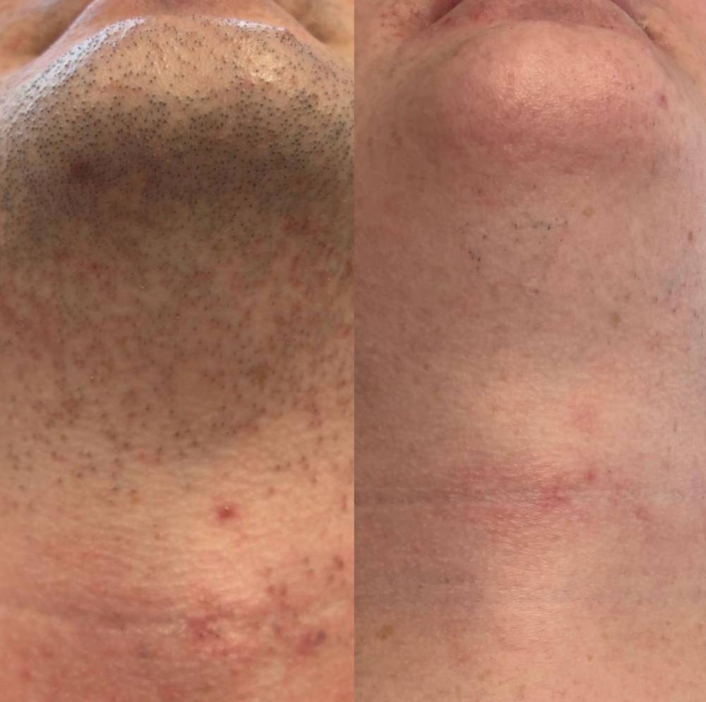 completed half face and neck package