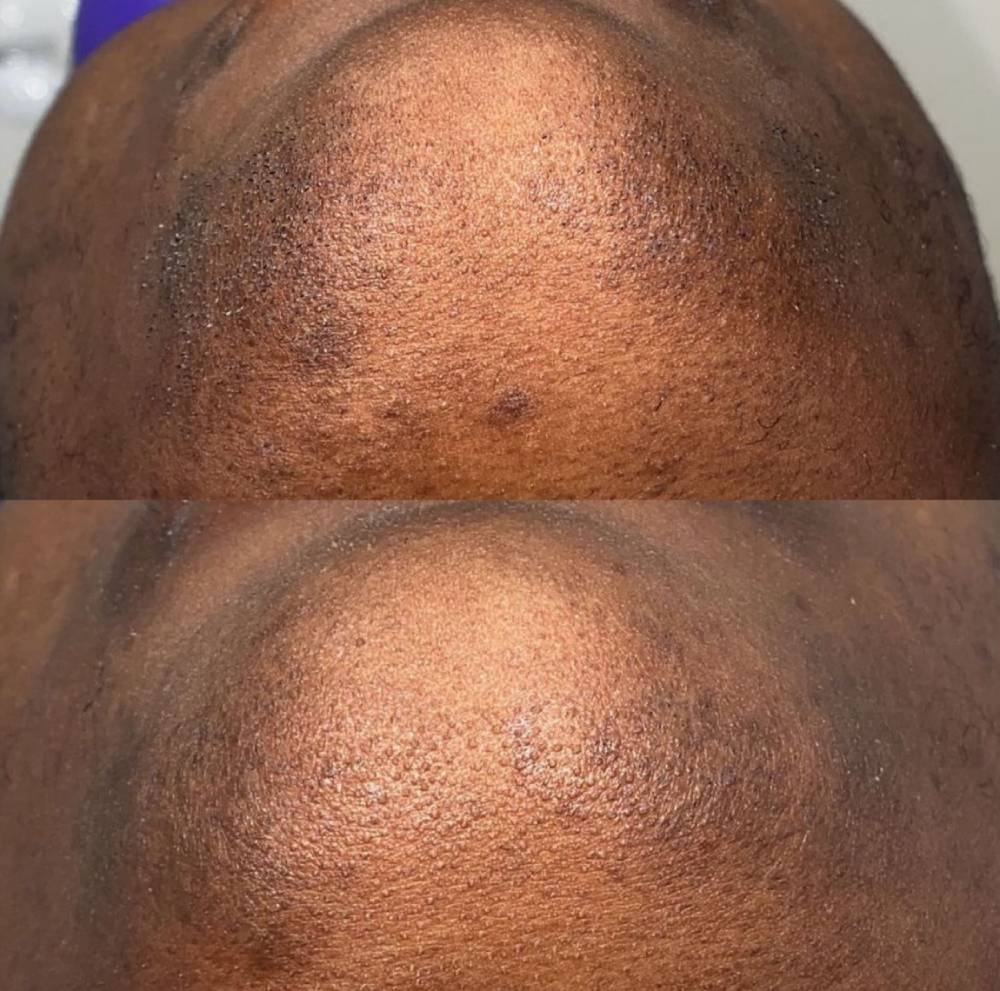 Dark skin laser hair removal