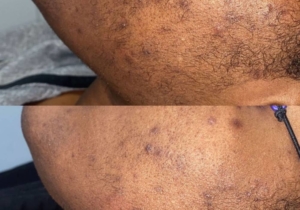 Dark skin laser hair removal