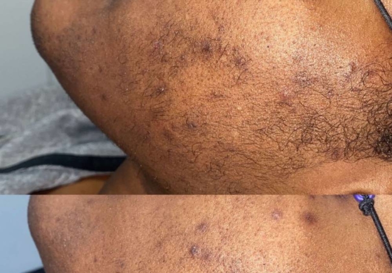 Dark skin laser hair removal