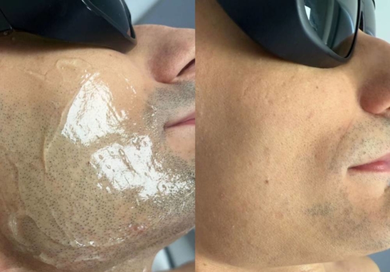 5 sessions half face