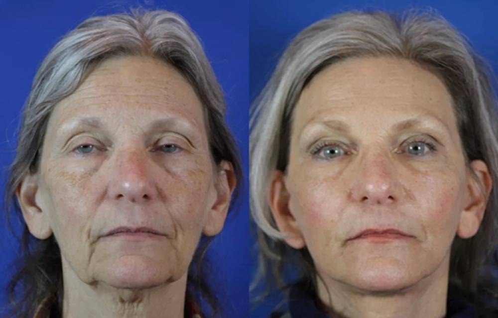 What is CO₂ laser skin resurfacing?