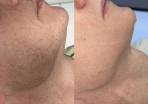 ﻿Weight-Loss Jabs & Laser Hair Removal: What You Need to Know Before Your Treatment