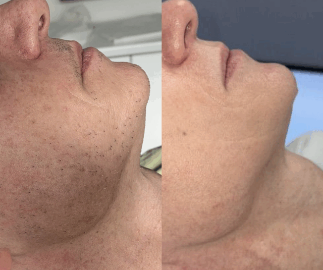 6 sessions half face