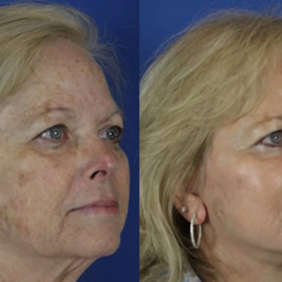 CO2 Laser Treatment at The Laser Club Manchester