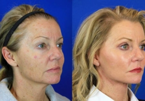 What is CO₂ laser skin resurfacing?