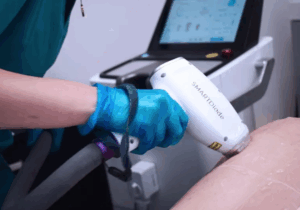 Laser Hair Removal Leeds: Is It Right for You?