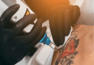 Effective Tattoo Removal Leeds: A Complete Guide
