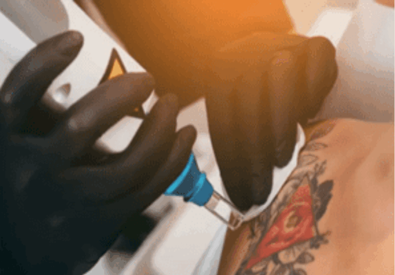 Effective Tattoo Removal Leeds: A Complete Guide