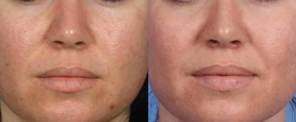 Pore Reduction