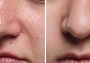 Pore Reduction Skin Treatment in Cheshire