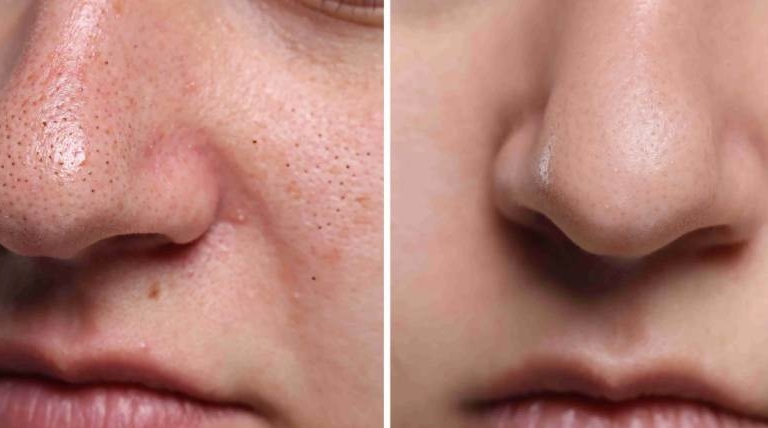 Pore Reduction