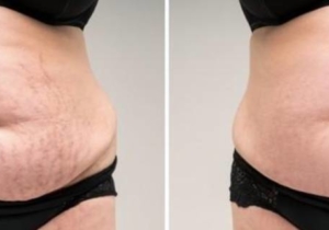 Stretch Mark Removal