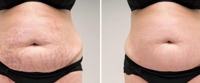 Stretch Mark Removal