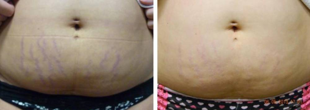 Stretch Mark Removal