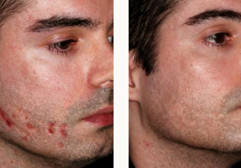 Scar Removal at The Laser Club