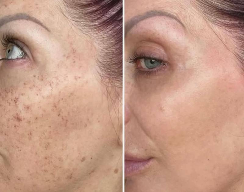 Treat Sun Damage in Cheshire