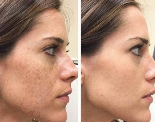 Treat Sun Damage in Cheshire