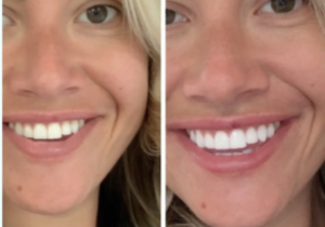 Teeth Whitening