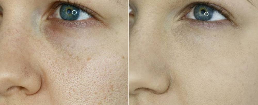 Remove Wrinkles in Cheshire