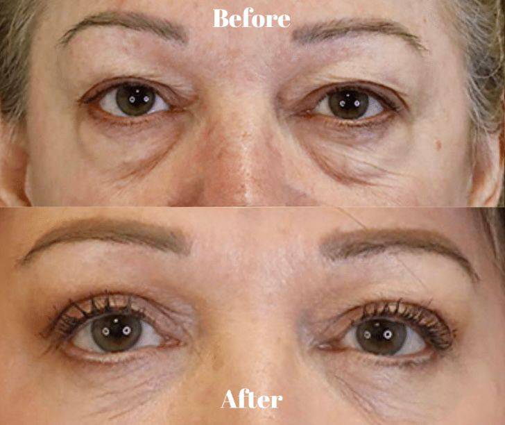 CO₂ Fractional Laser Manchester