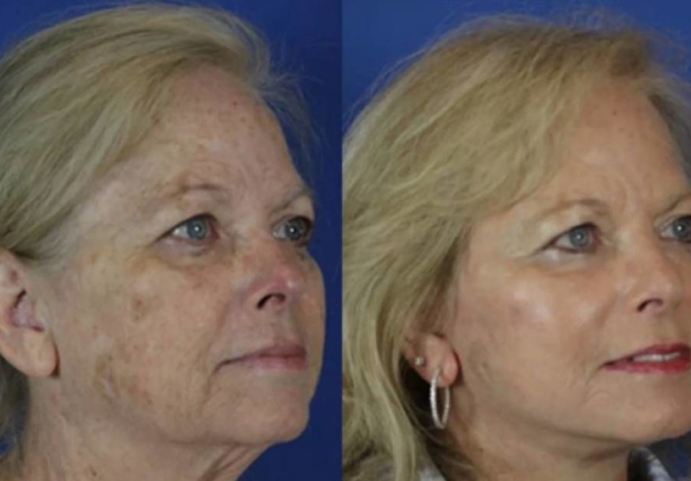 Why People Are Ditching Fillers and Botox for Laser Treatments