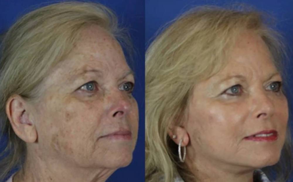 Laser Treatments