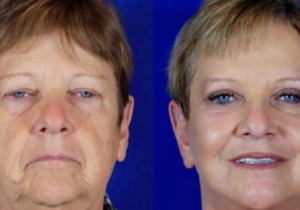 CO₂ Fractional Laser Treatment in Manchester