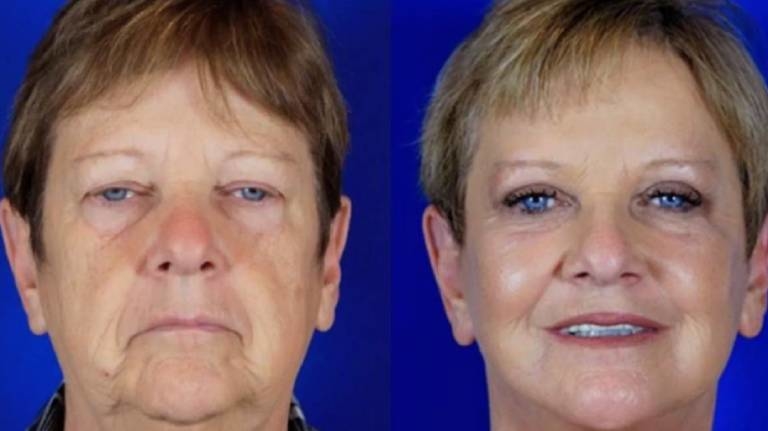 CO₂ Fractional Laser Treatment in Manchester