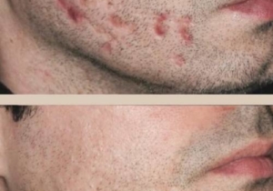 Battling Acne: Understanding Your Skin & Choosing the Right Treatment at The Laser Club