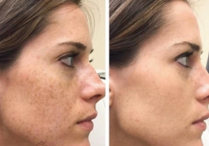 Transform Your Skin with ResurFX at The Laser Club Cheshire