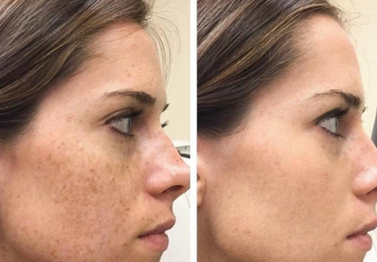 Transform Your Skin with ResurFX at The Laser Club Cheshire