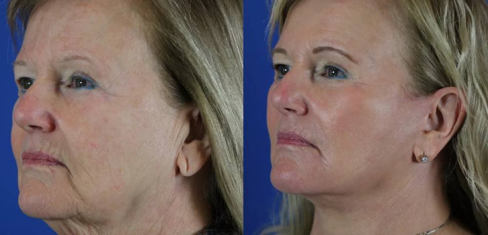 Why Choose CO₂ Fractional Laser at The Laser Club Manchester