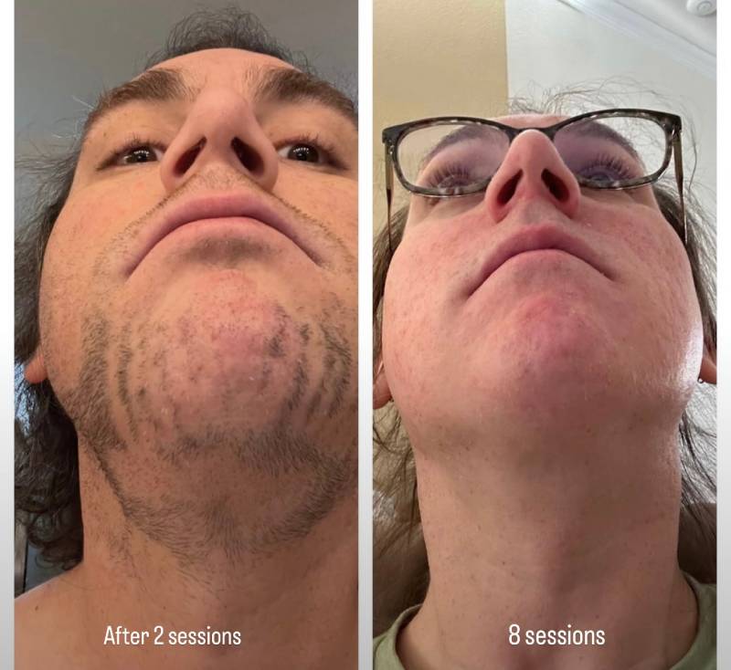 trans beard laser hair removal before and after