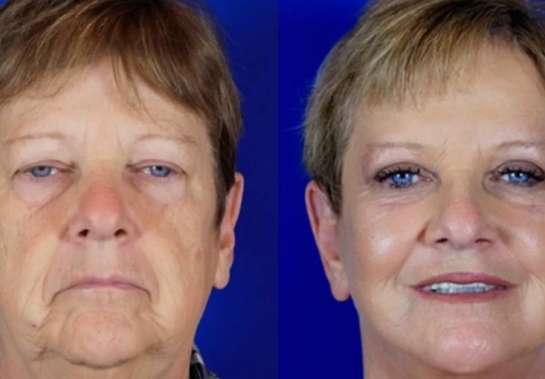 CO₂ Fractional Laser Treatment in Manchester