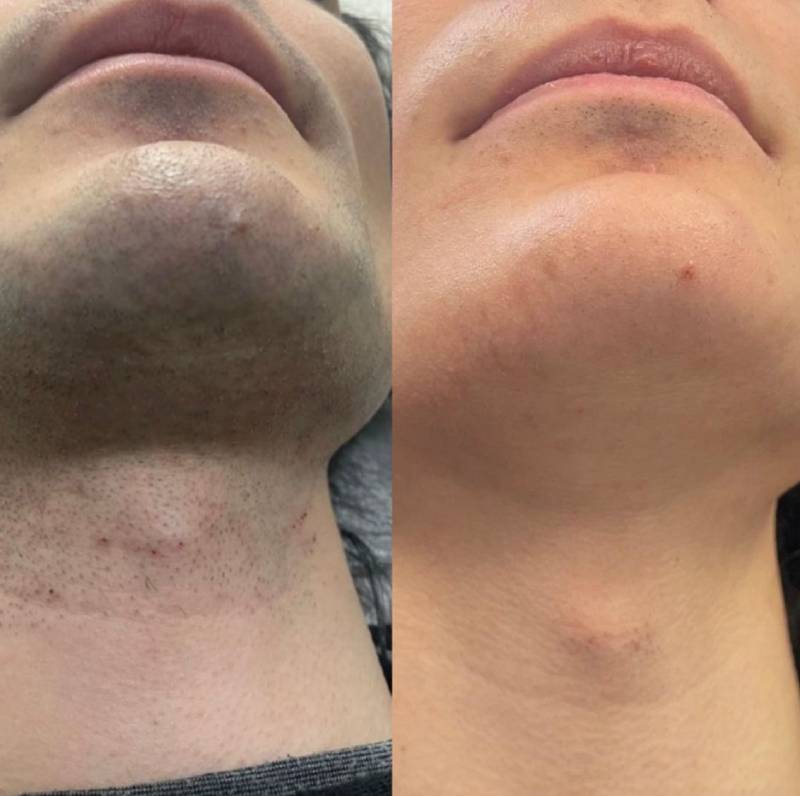 Beard Removal Manchester