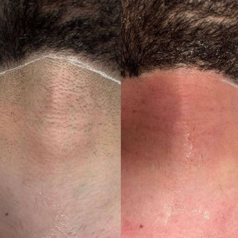 Beard Removal Manchester