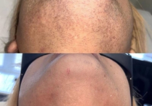 Beard Removal Manchester – The Ultimate Guide to Safe, Permanent Facial Hair Removal for Men