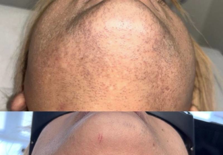 Beard Removal Manchester – The Ultimate Guide to Safe, Permanent Facial Hair Removal for Men