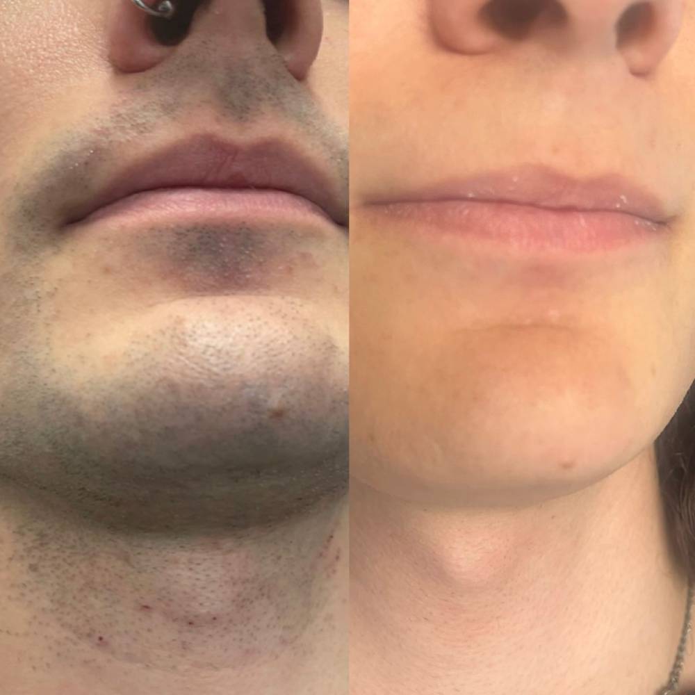 trans beard laser hair removal before and after
