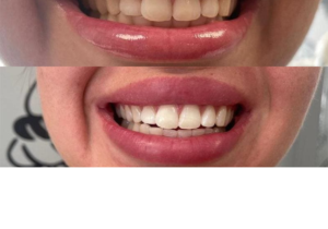 laser teeth whitening cheshire