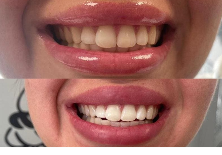 laser teeth whitening cheshire