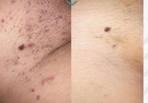 Laser Hair Removal Manchester