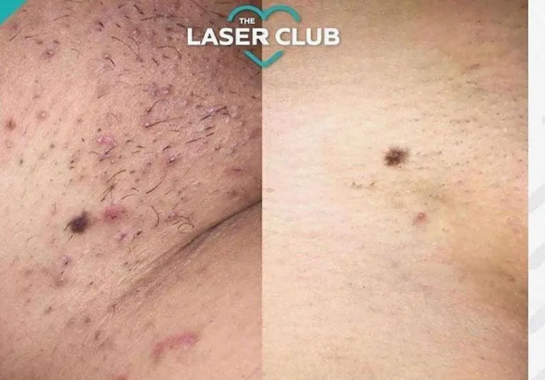 Laser Hair Removal Manchester
