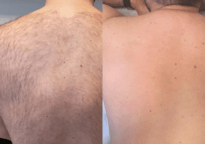 Laser hair removal for men Manchester